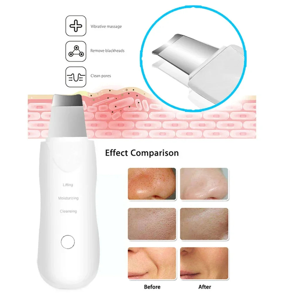 Ultrasonic Facial Skin Scrubber – Ion Deep Cleansing & Exfoliation Device UK